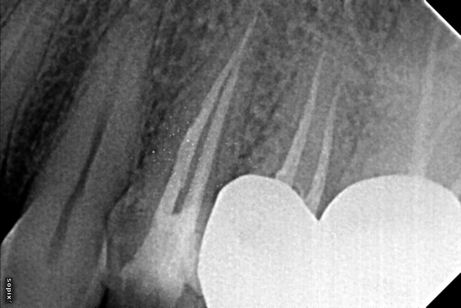 Root Canal Treatment